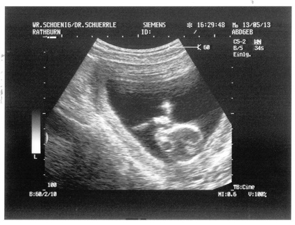 Ultrasound 13May2013b